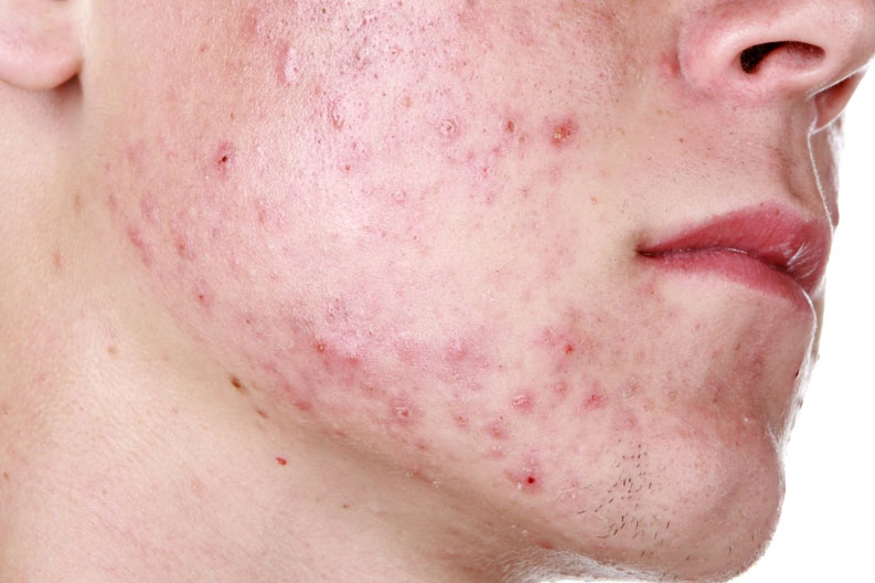 Acne-Study.jpg