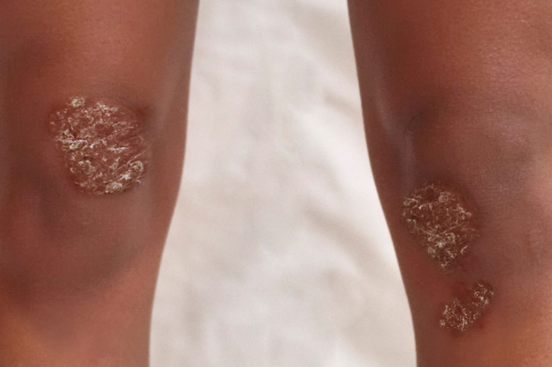 AdultPsoriasis.jpg