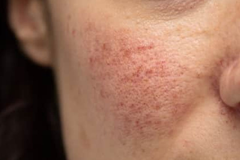 Rosacea.jpg