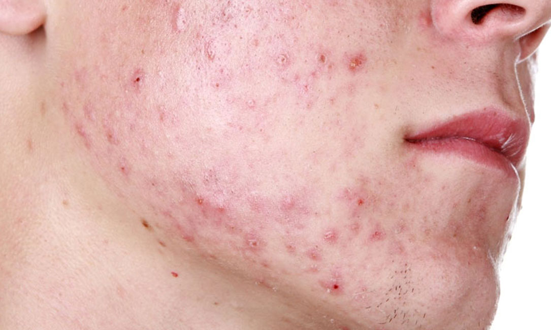 Acne And Hidradenitis Suppurativa Arlington Skin Doctor